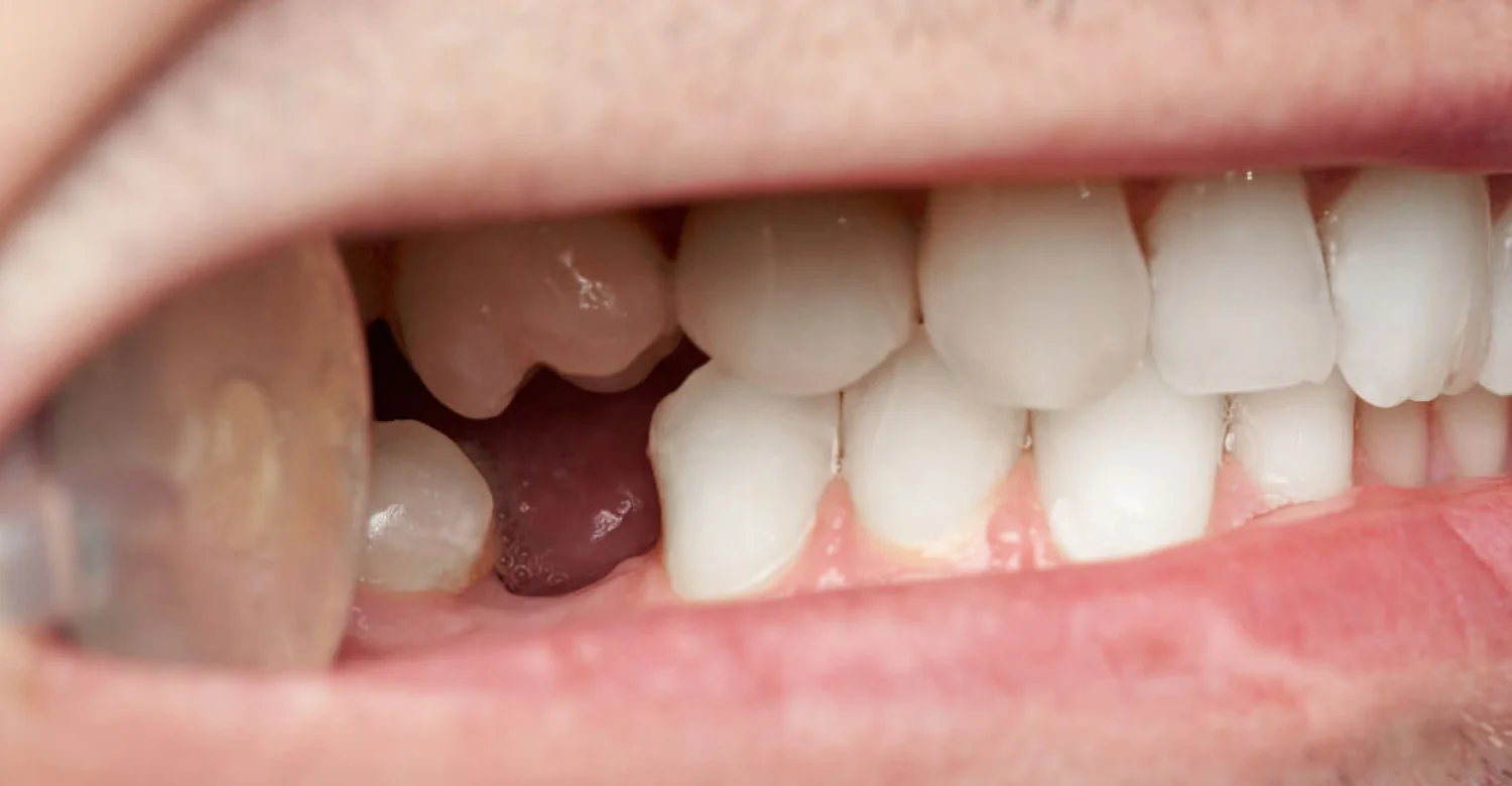Missing Teeth Chewing Problems inblog